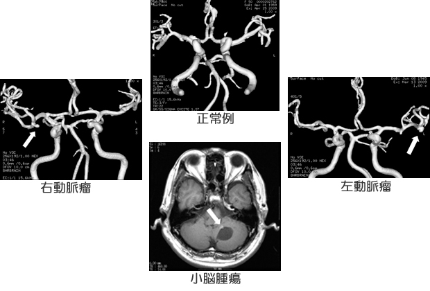 MRI・MRA画像例